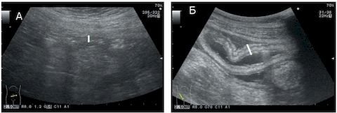 Ultrasound of the small intestine