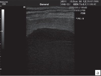 Ultrasound in MRI mode - giant primary splenic cyst
