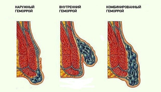 Types of hemorrhoids