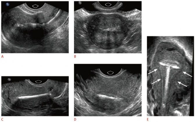 Intrauterine device on ultrasound