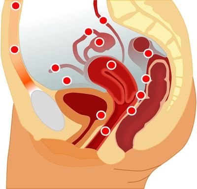 Possible areas of development of endometriosis