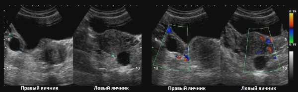 Ovary on ultrasound
